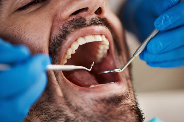 Dental Bonding in Emerald Bay, TX